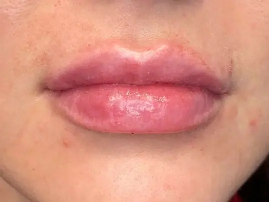 Restylane Lip Fillers after treatment at ZO Skin Centre Dallas