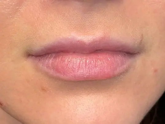 Restylane Lip Fillers before treatment at ZO Skin Centre Dallas