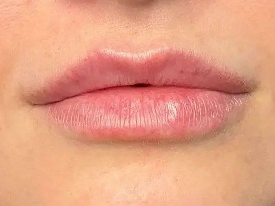 Restylane Kysse Lip Fillers after treatment at ZO Skin Centre Dallas