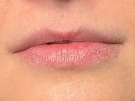 Restylane Kysse Lip Fillers before treatment at ZO Skin Centre Dallas