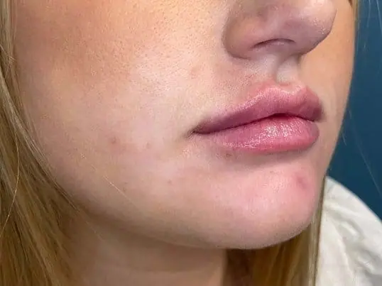 Versa lip filler for volume and hydration after treatment at ZO Skin Centre Dallas