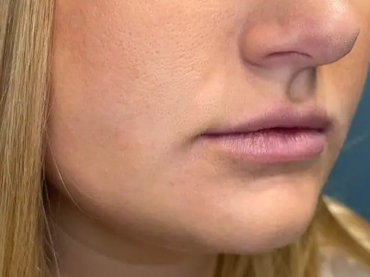 Versa lip filler for volume and hydration before treatment at ZO Skin Centre Dallas
