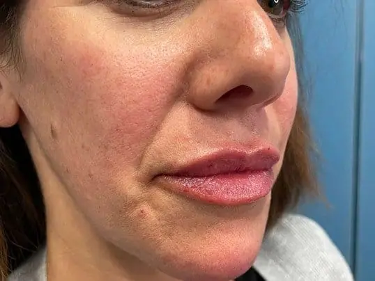 Restylane Kysse Lip Filler after treatment at ZO Skin Centre Dallas
