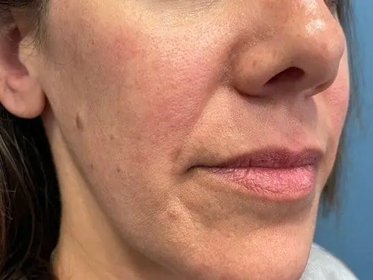 Restylane Kysse Lip Filler before treatment at ZO Skin Centre Dallas