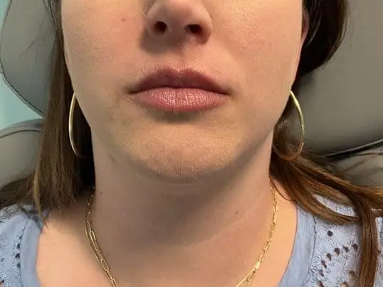 Restylane Lip Filler Treatment after treatment at ZO Skin Centre Dallas