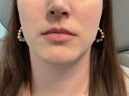 Restylane Lip Filler Treatment before treatment at ZO Skin Centre Dallas