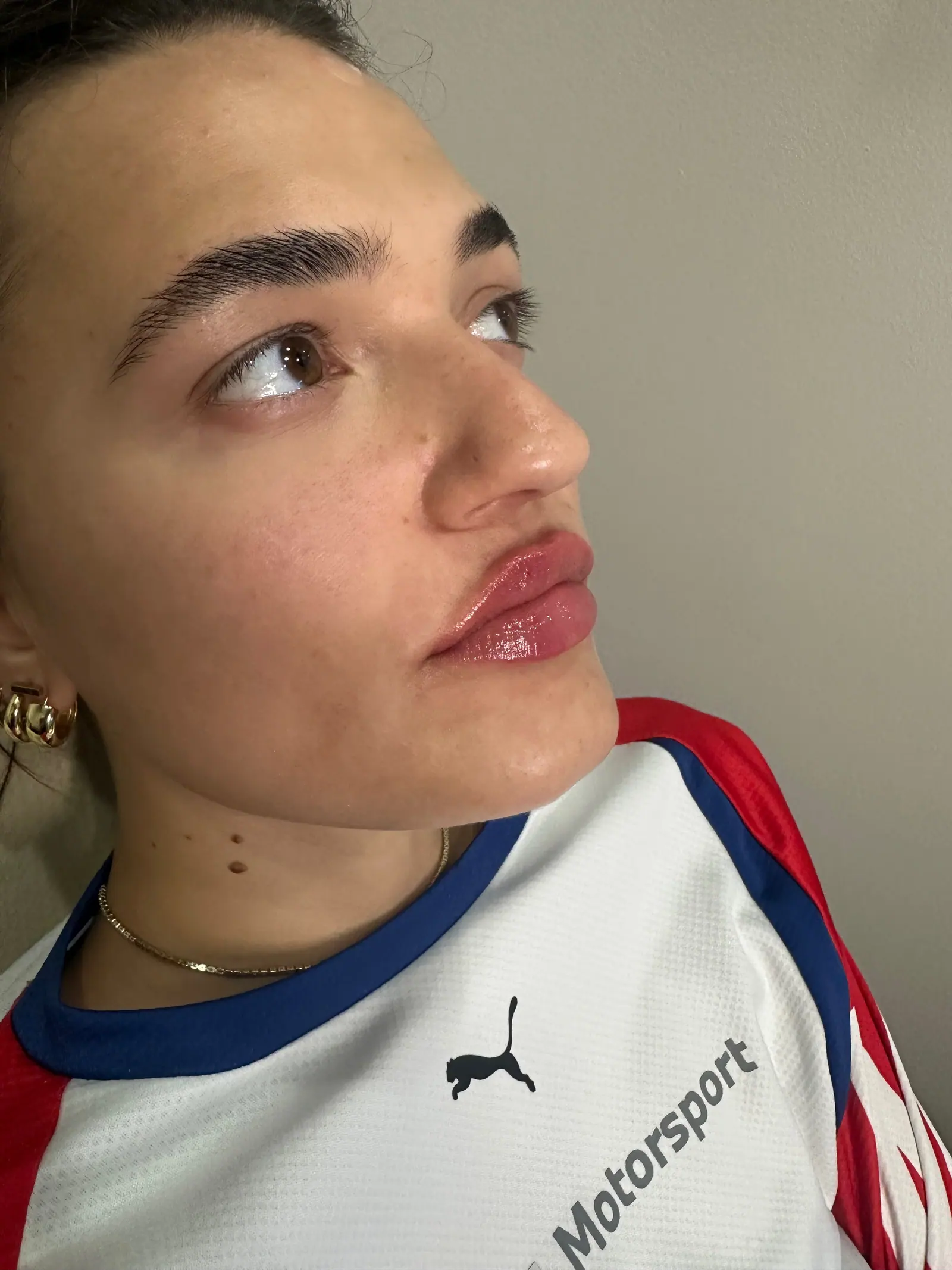 Mini Lip Filler Case 1 after