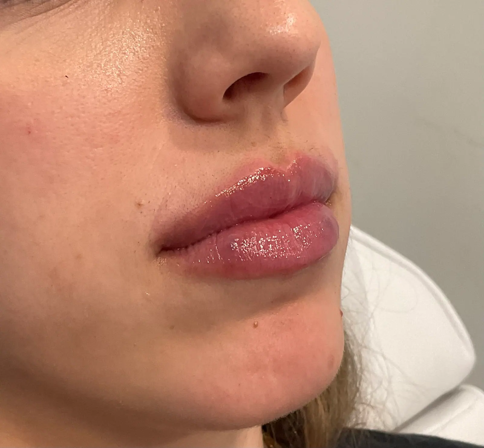 Mini Lip Filler Case 2 after