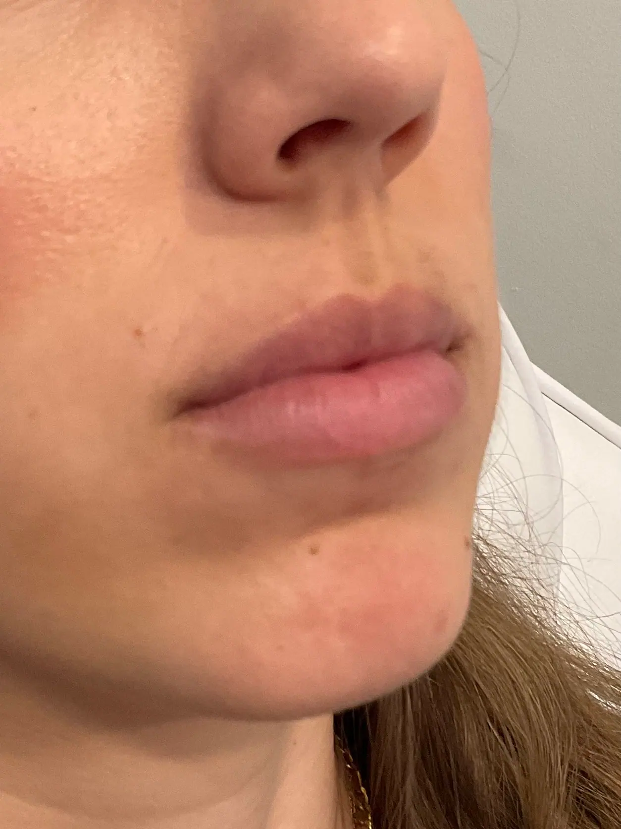 Mini Lip Filler Case 2 before