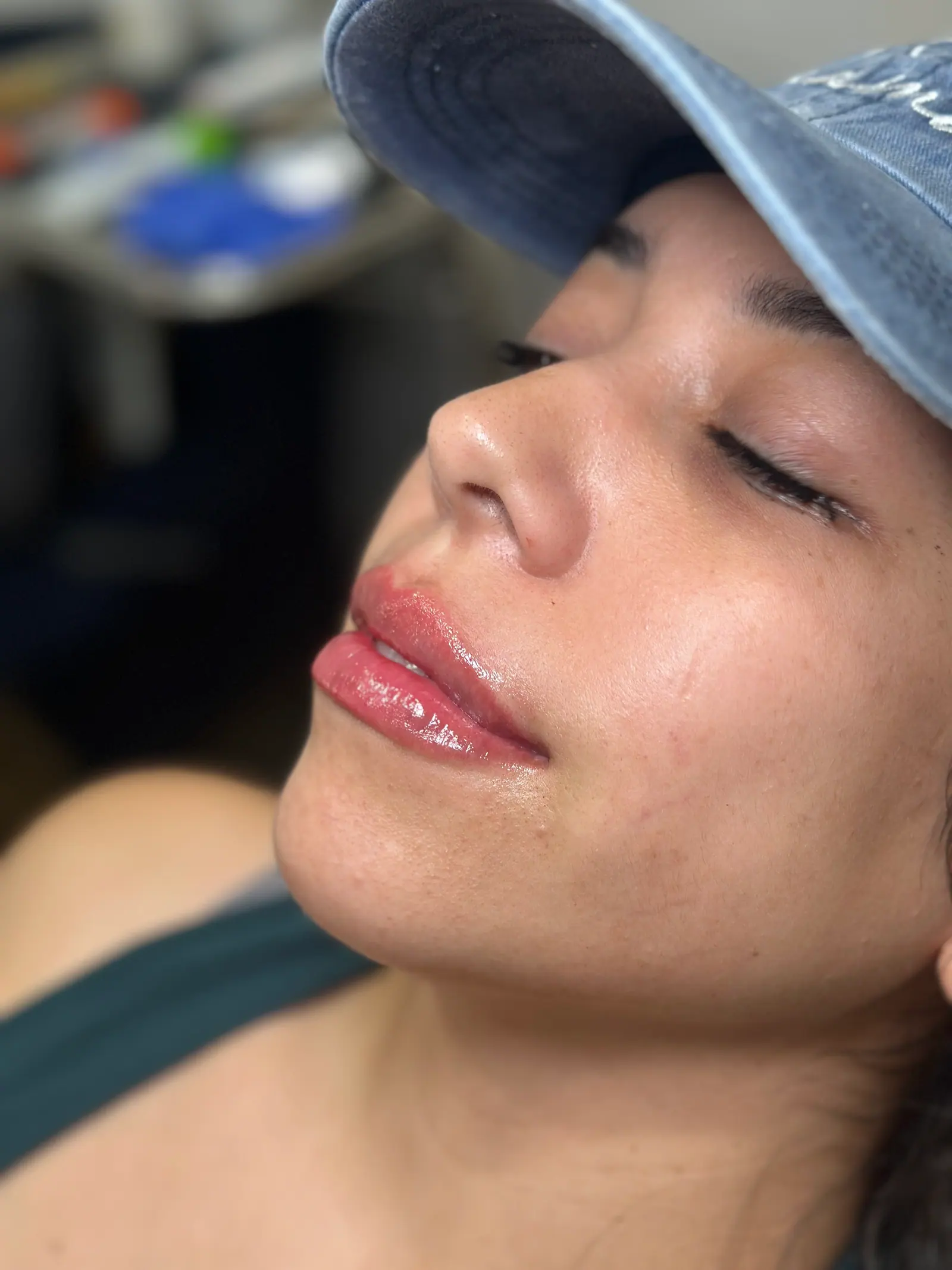 Mini Lip Filler Case 3 after