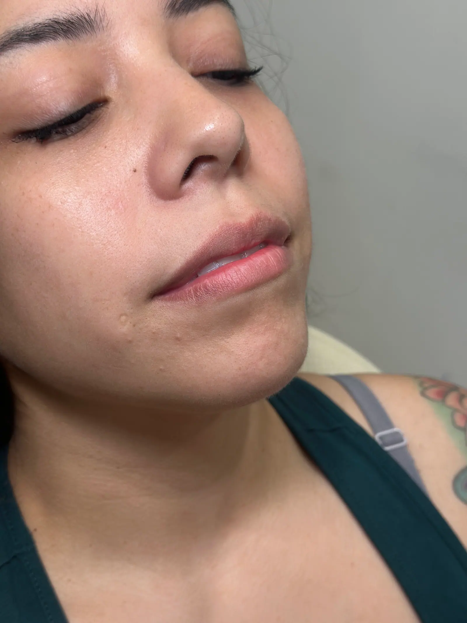 Mini Lip Filler Case 3 before