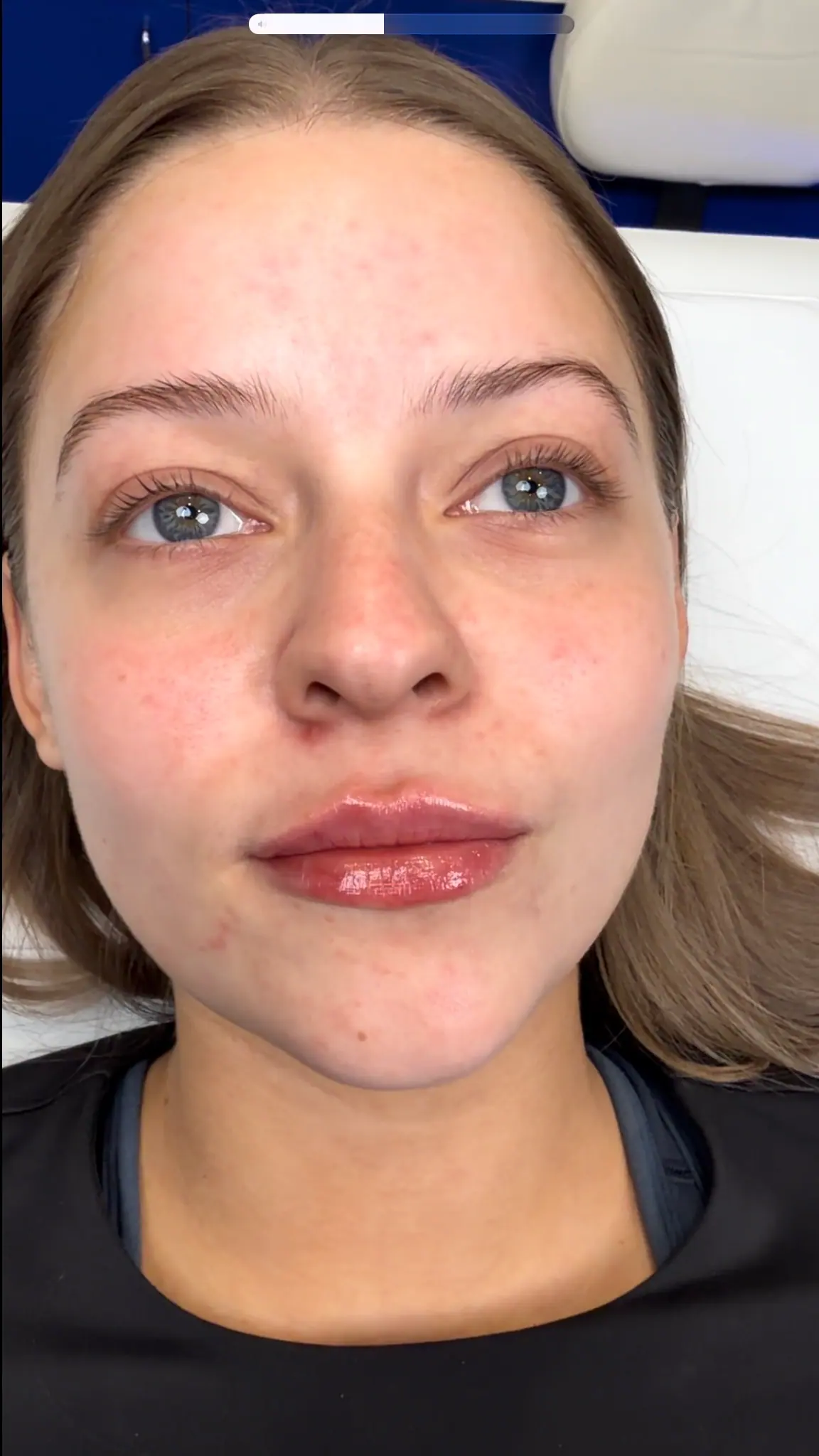 Mini Lip Filler Case 4 after treatment at ZO Skin Centre Houston