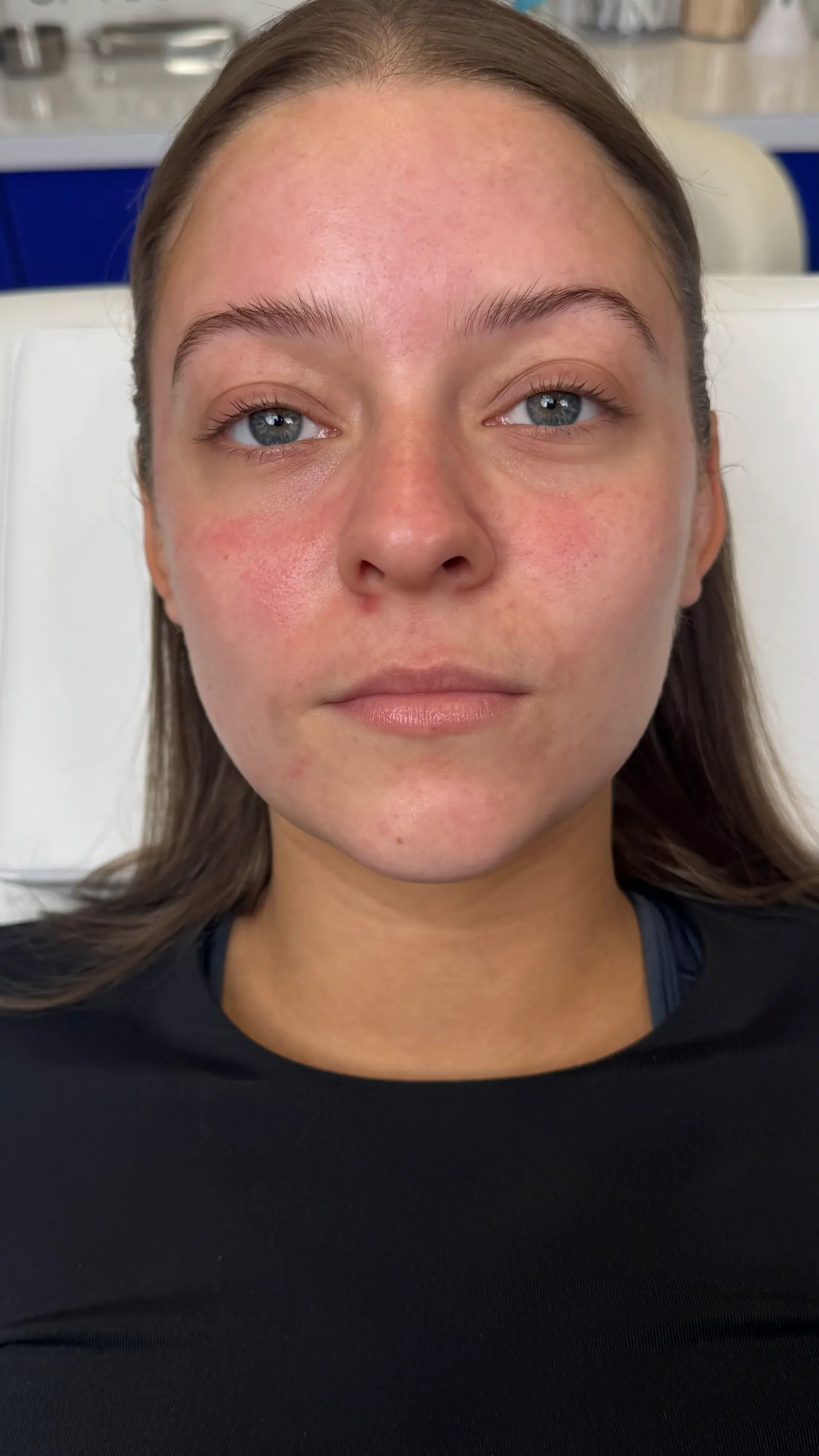 Mini Lip Filler Case 4 before treatment at ZO Skin Centre Houston