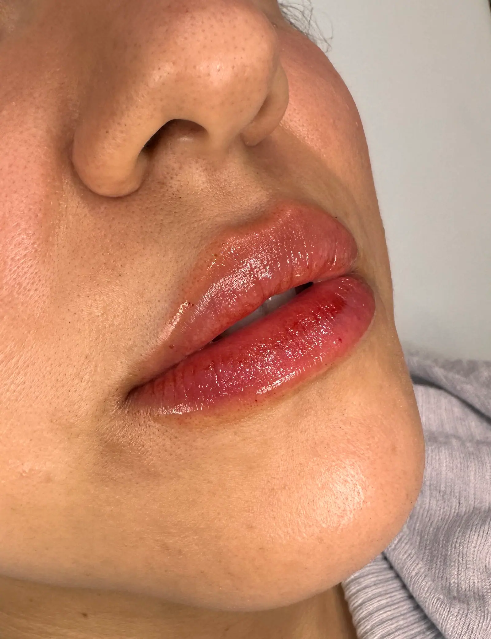 Mini Lip Filler Case 5 after treatment at ZO Skin Centre Houston