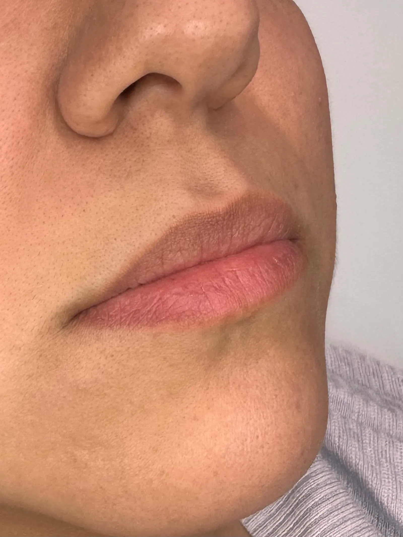 Mini Lip Filler Case 5 before treatment at ZO Skin Centre Houston