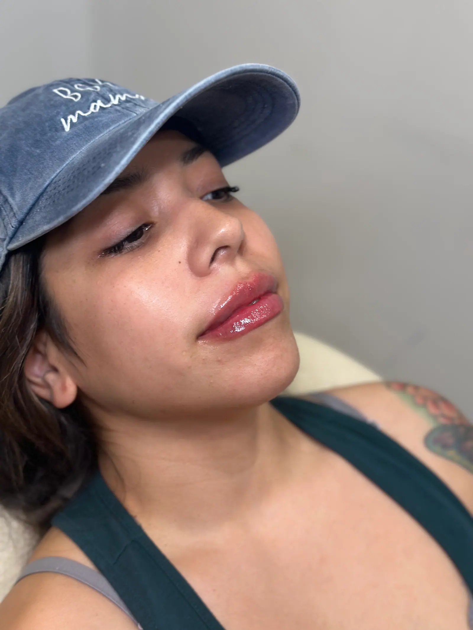 Mini Lip Filler Case 6 after treatment at ZO Skin Centre Houston