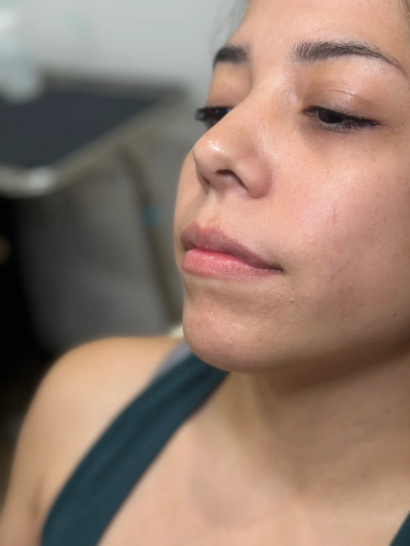 Mini Lip Filler Case 6 before treatment at ZO Skin Centre Houston