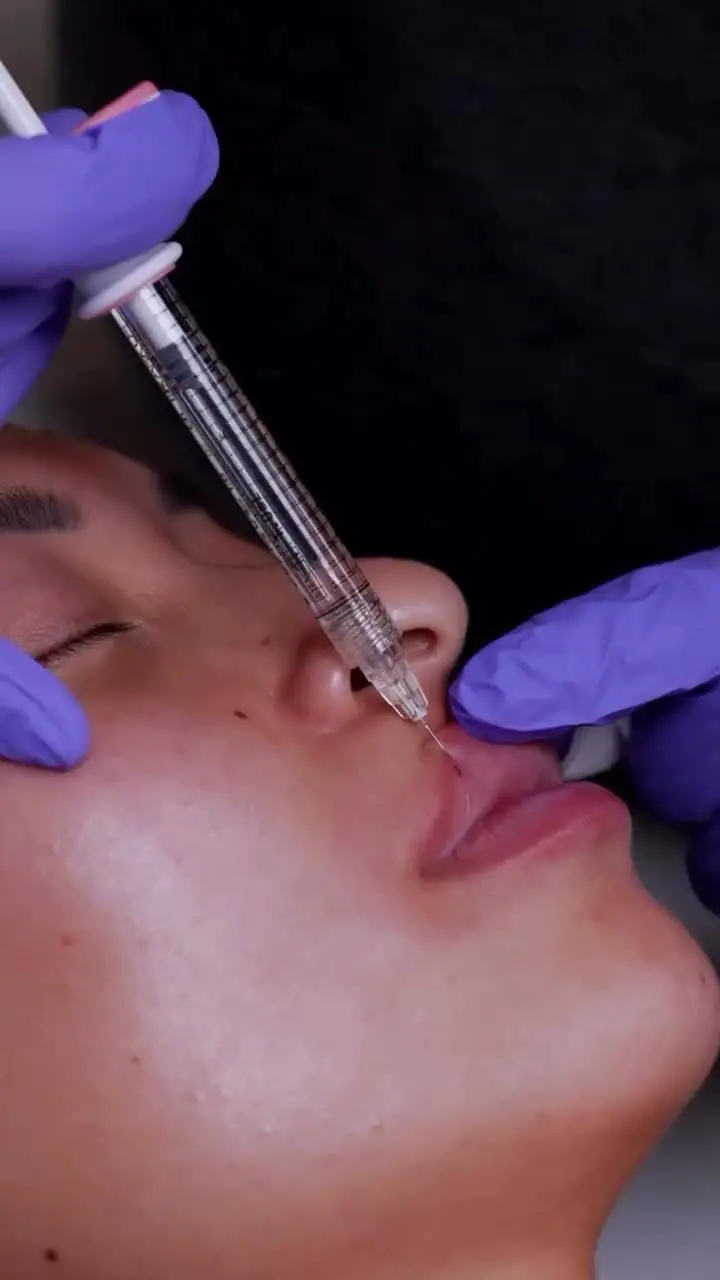 Lip Filler treatment detail