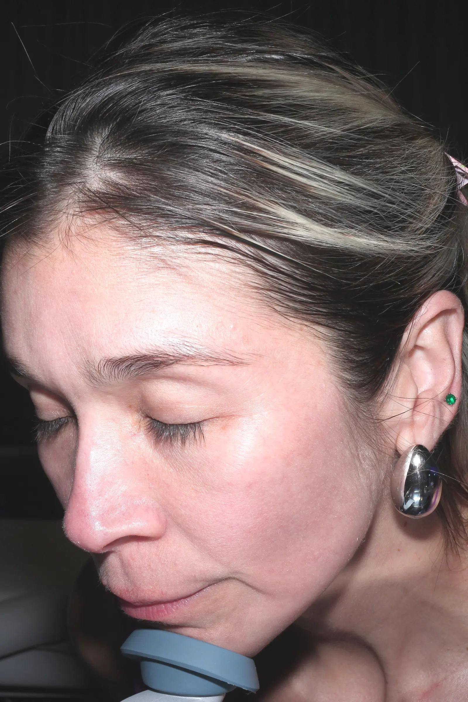 Melasma Treatment by Mini after treatment at ZO Skin Centre Houston