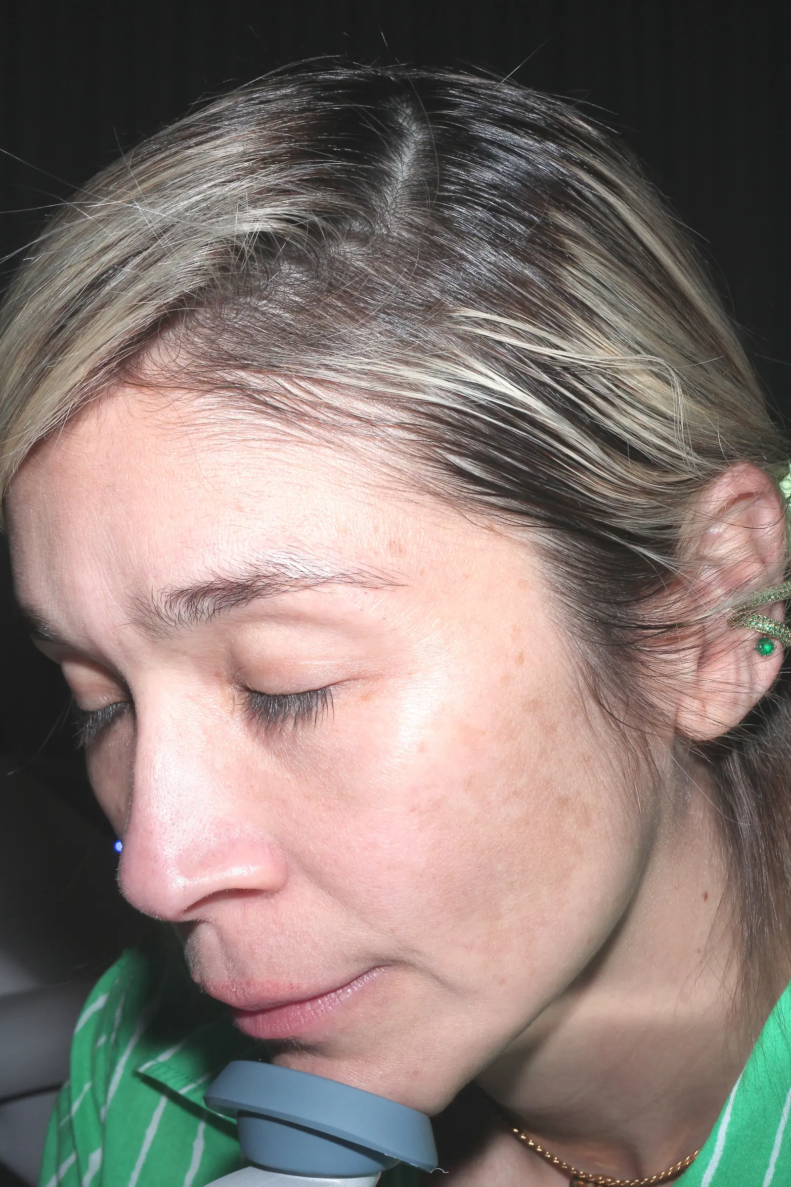 Melasma Treatment by Mini before treatment at ZO Skin Centre Houston