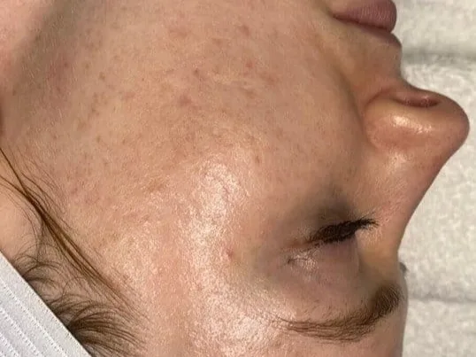 Shallow acne scars and uneven texture on the cheek before SkinPen