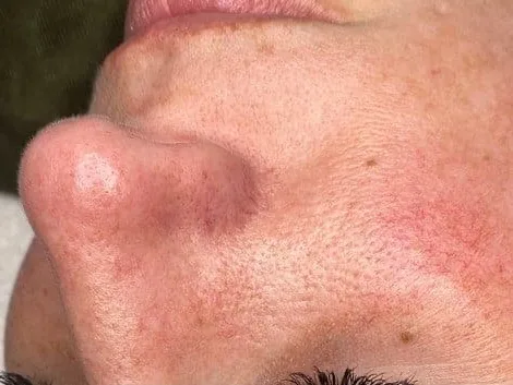 Rough, uneven cheek texture on a clinic patient