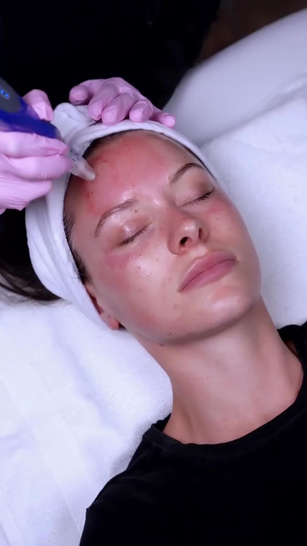 Microneedling treatment detail