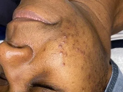 Pitted scars on the cheek of a clinic patient. The photo shows the concern. It is not a treatment result.