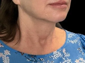 Softening along the jaw and creases on the neck of a clinic patient. The photo shows the concern. It is not a treatment result.