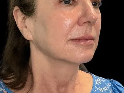 A flatter cheek on a clinic patient. The photo shows the concern. It is not a treatment result.