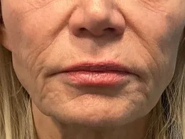 Lines around the mouth on a clinic patient. The photo shows the concern. It is not a treatment result.