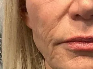 Thin, crepey skin along the cheek and mouth of a clinic patient. The photo shows the concern. It is not a treatment result.