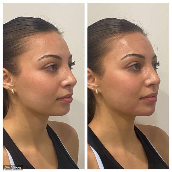 Chin Filler Near Me Before and After