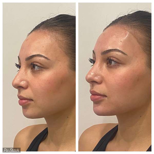 Chin Filler Near Me Before and After