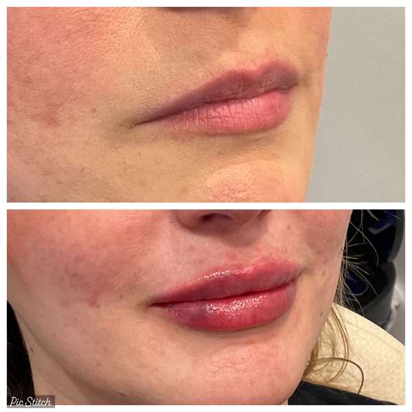 Restylane Defyne - first time lip filler before and after at ZO Skin Centre Houston