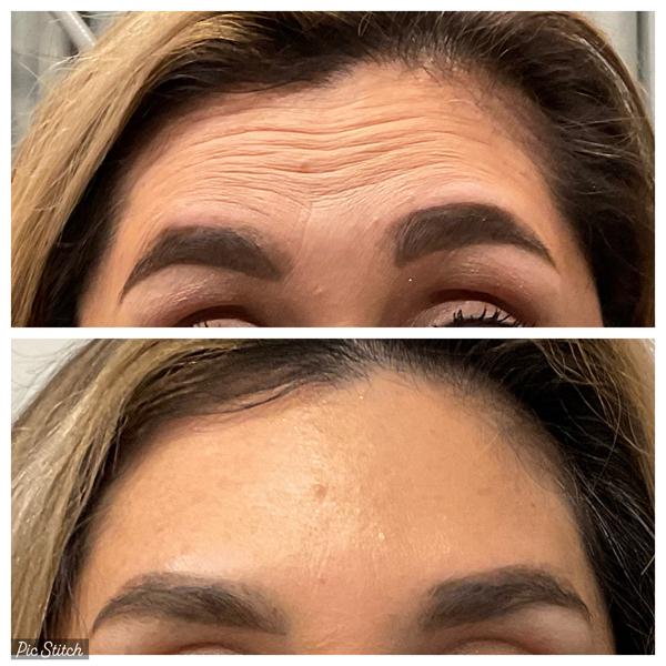 Botox for Forehead before and after - ZO Skin Centre Houston