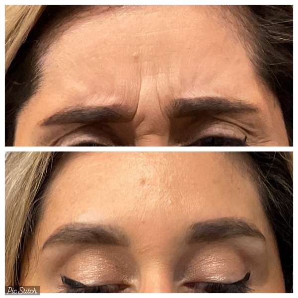 Injectables before & after
