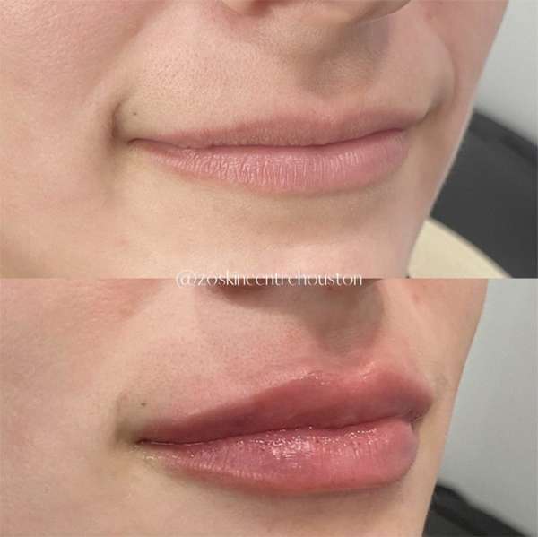 Lip Filler Before and After at ZO Skin Centre Houston