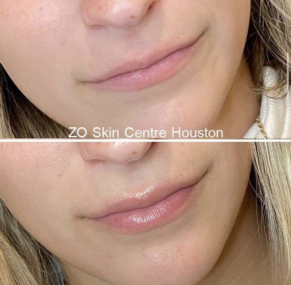 Lip Flip vs Filler before and after at ZO Skin Centre Houston