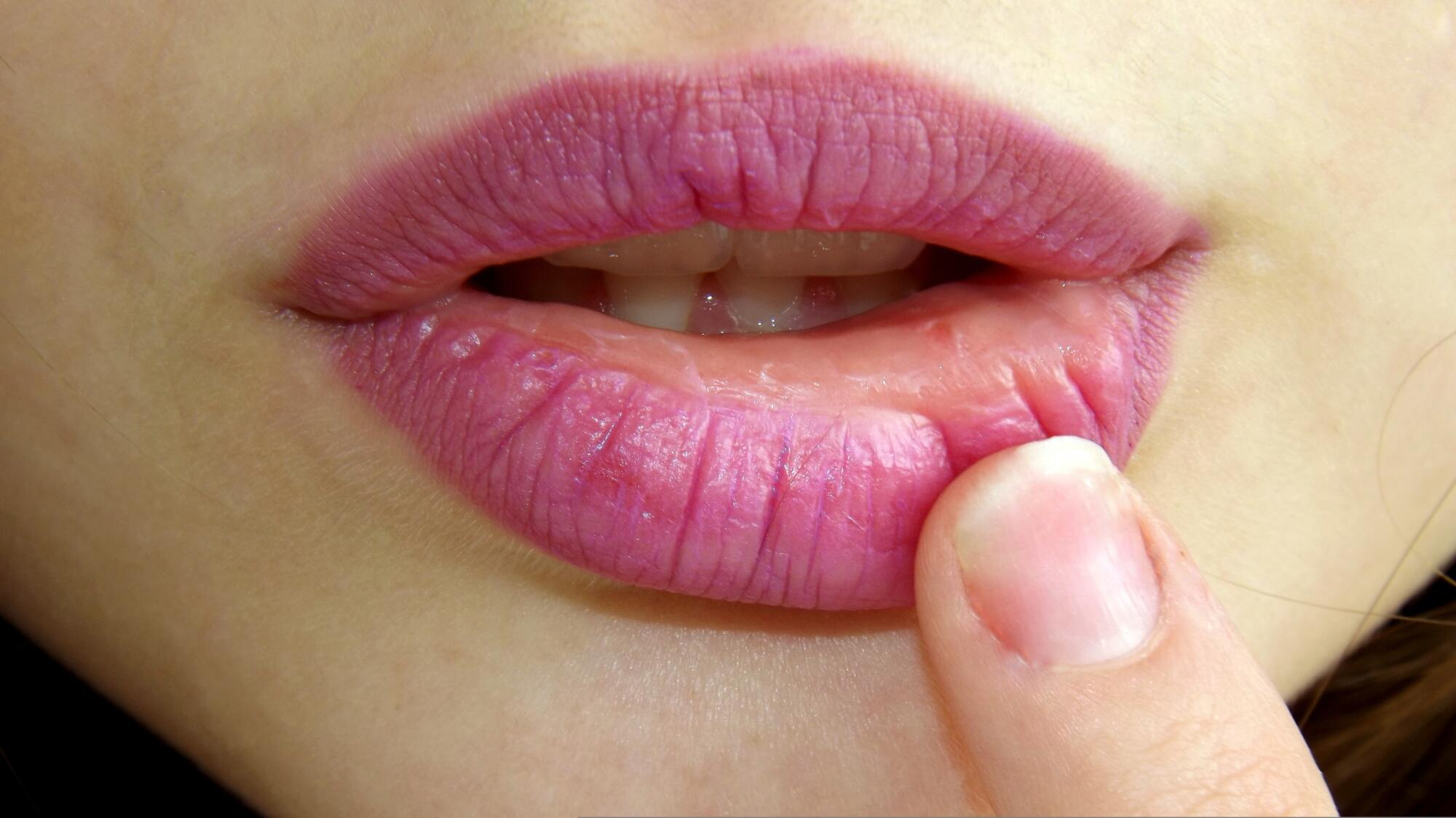 lip filler lips